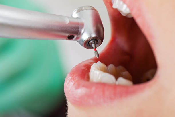 Best Broken or Chipped Tooth Repair in Eatonton, GA